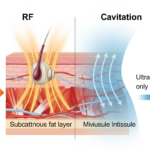 Cryolipolysis vs. RF vs. Cavitation: How to Choose the Best Body Contouring Technology for Your Business?
