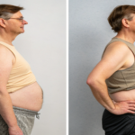 Non-Invasive Body Contouring Technologies
